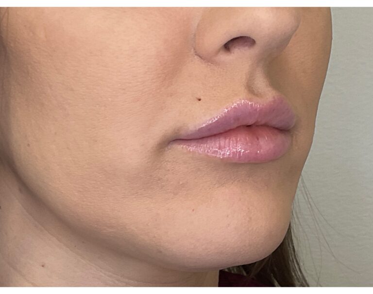Before Image: Lip Filler - right-front-oblique