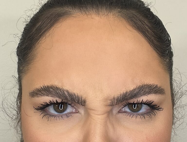 Before Image: Botox - front