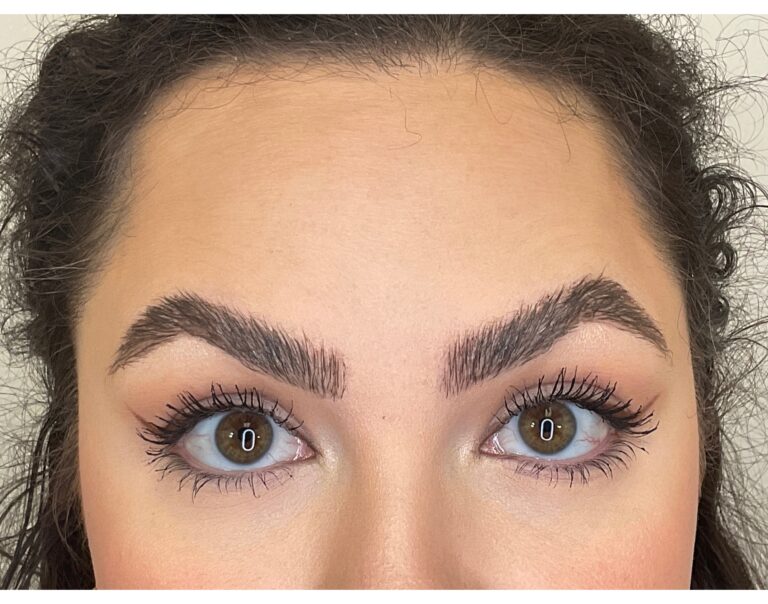 After Image: Botox - front