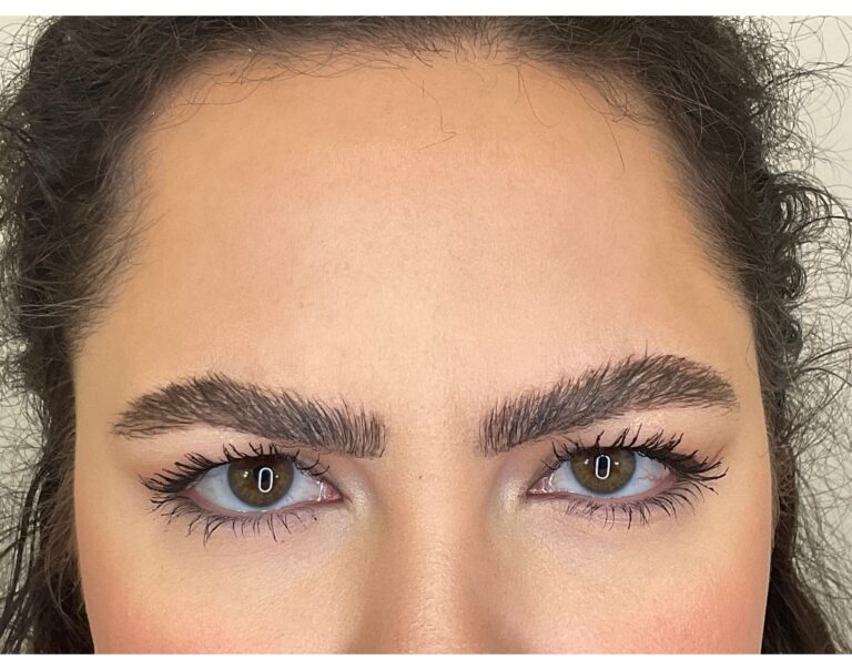 After Image: Botox - front