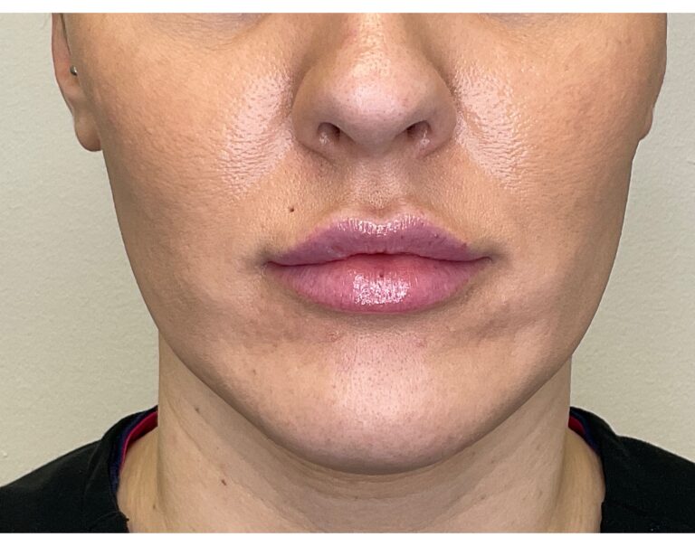 After Image: Lip Filler - front