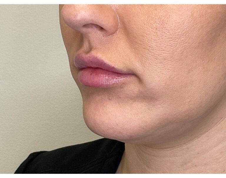 After Image: Lip Filler - left-front-oblique