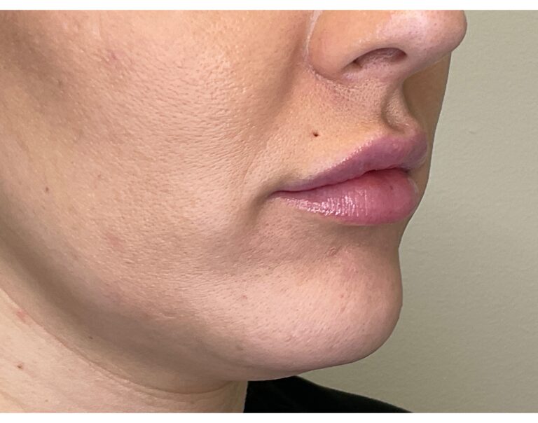 After Image: Lip Filler - right-front-oblique