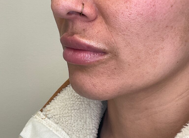 After Image: Lip Filler - left-front-oblique