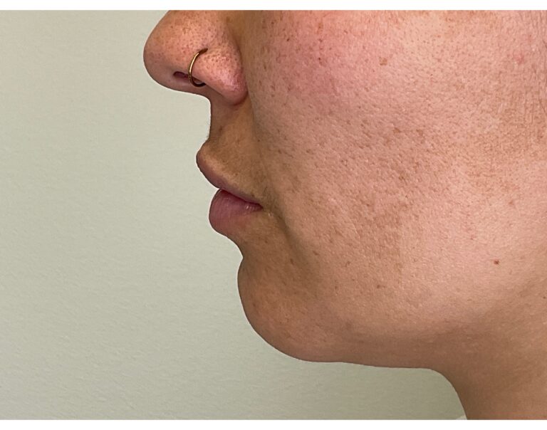 Before Image: Lip Filler - left-side