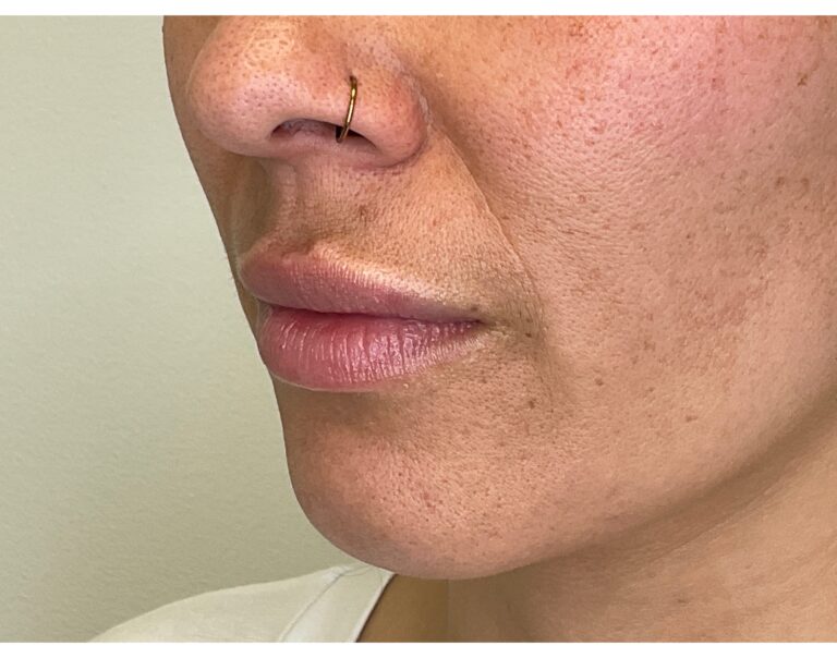 Before Image: Lip Filler - left-front-oblique
