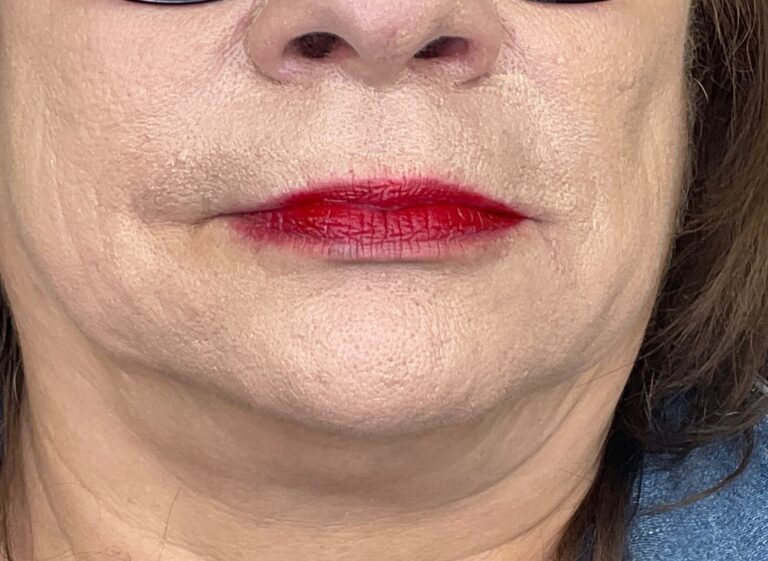 After Image: Filler: NLF/ML - front