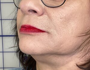 After Image: Filler: NLF/ML