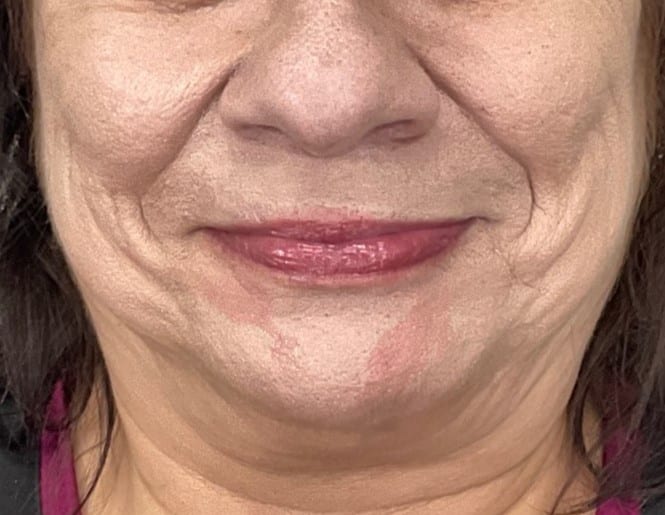 Before Image: Filler: NLF/ML - front