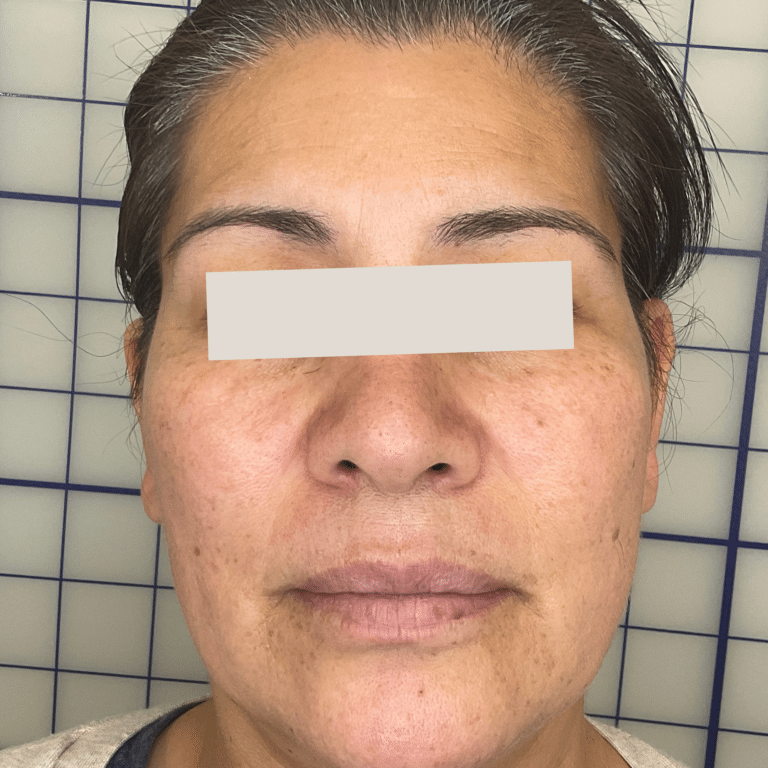 Before Image: PicoSure - front