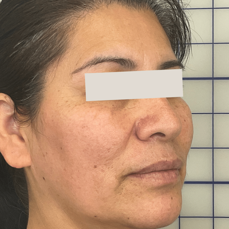 Before Image: PicoSure - right-front-oblique
