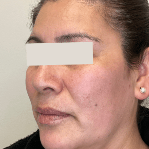 After Image: PicoSure