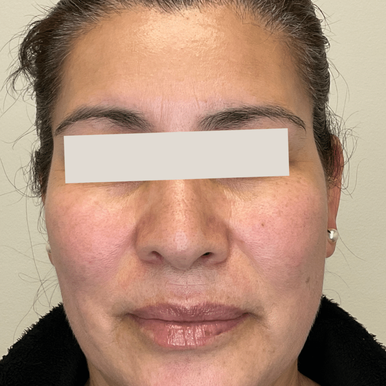 After Image: PicoSure - front