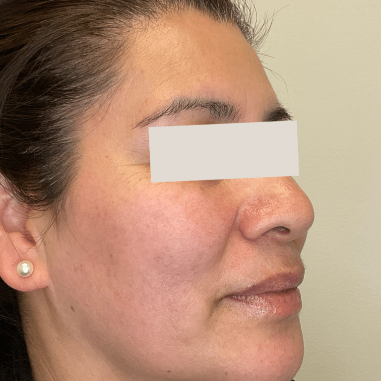 After Image: PicoSure - right-front-oblique