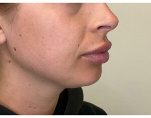 After Image: Volbella Lip Filler