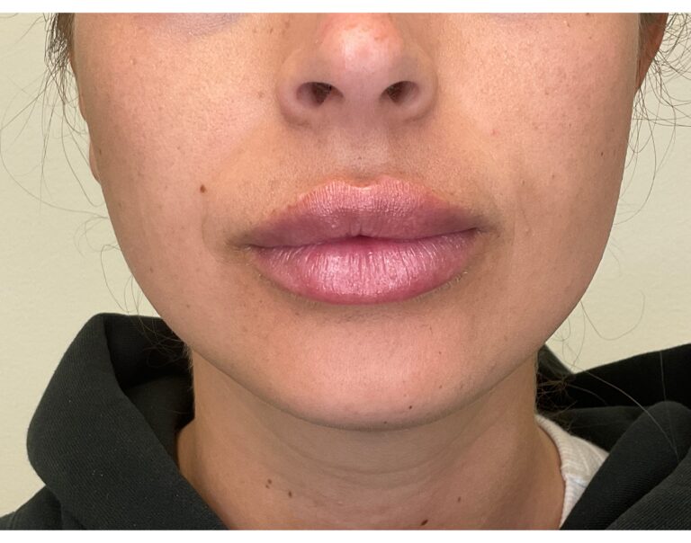 After Image: Volbella Lip Filler - front