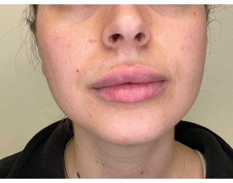 Before Image: Volbella Lip Filler - front