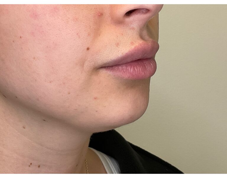 Before Image: Volbella Lip Filler - right-front-oblique
