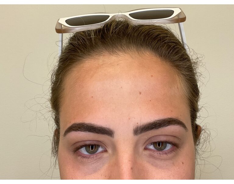 After Image: Botox -
