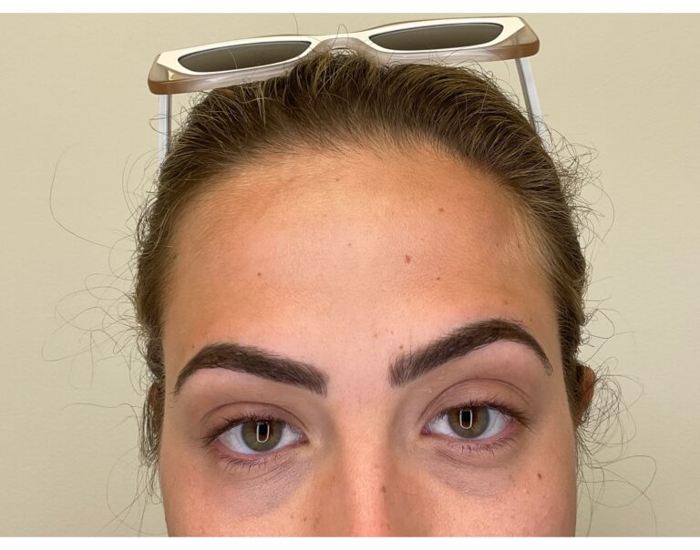 After Image: Botox - front