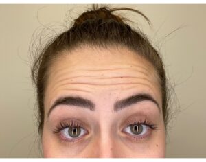 Botox