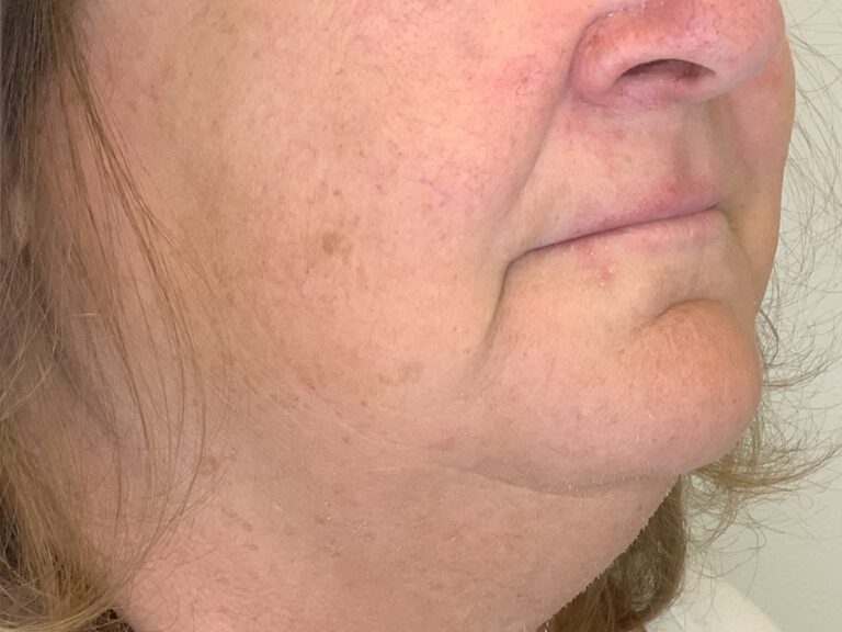 After Image: LHR: Upper Lip, Chin, & Neck - right-front-oblique