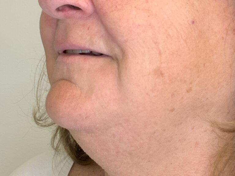 After Image: LHR: Upper Lip, Chin, & Neck - left-front-oblique