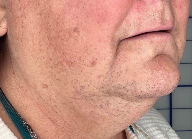 Before Image: LHR: Upper Lip, Chin, & Neck - right-front-oblique
