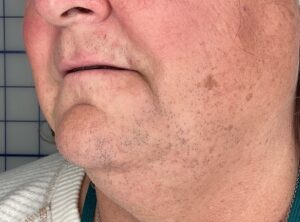 Before Image: LHR: Upper Lip, Chin, & Neck