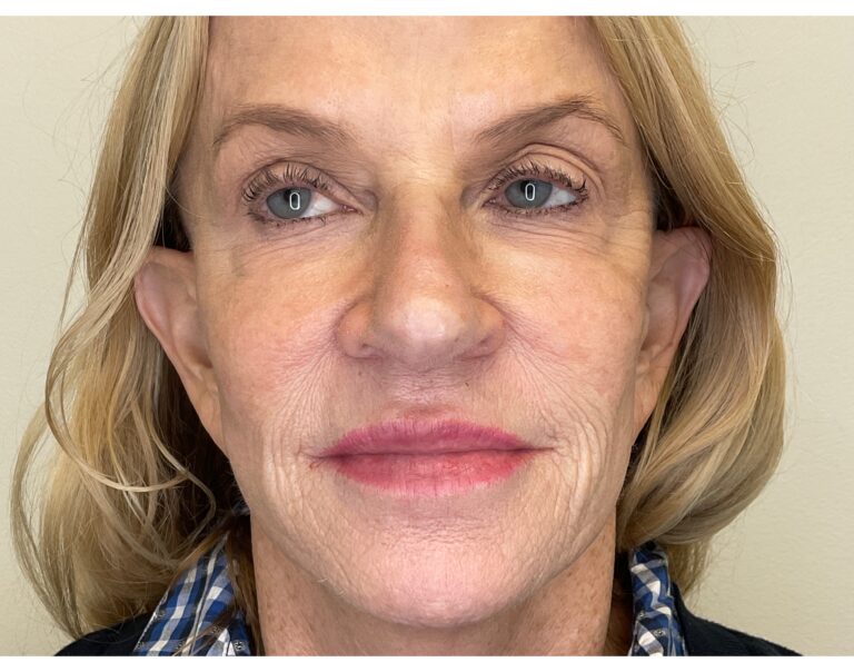 After Image: Facial Fillers - front