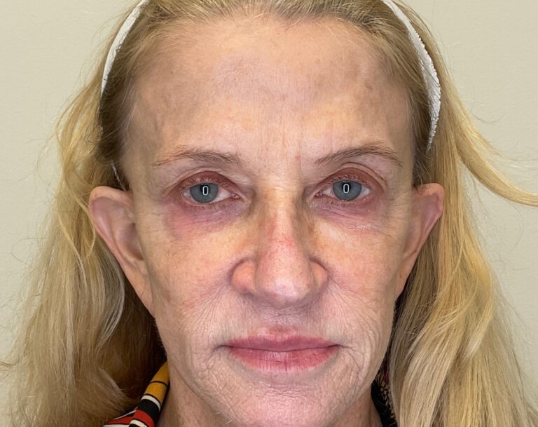 Before Image: Facial Fillers - front