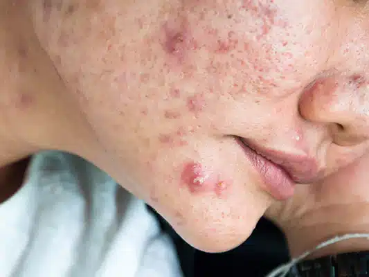 cystic acne 1024x400