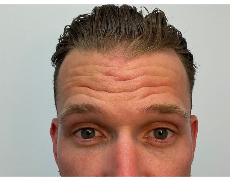 Before Image: Botox - front