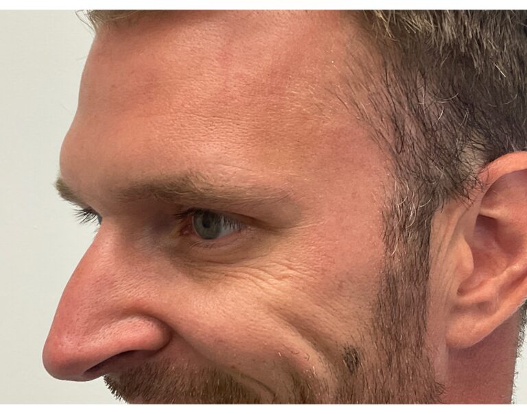 After Image: Botox - left-side