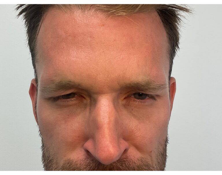 After Image: Botox - front