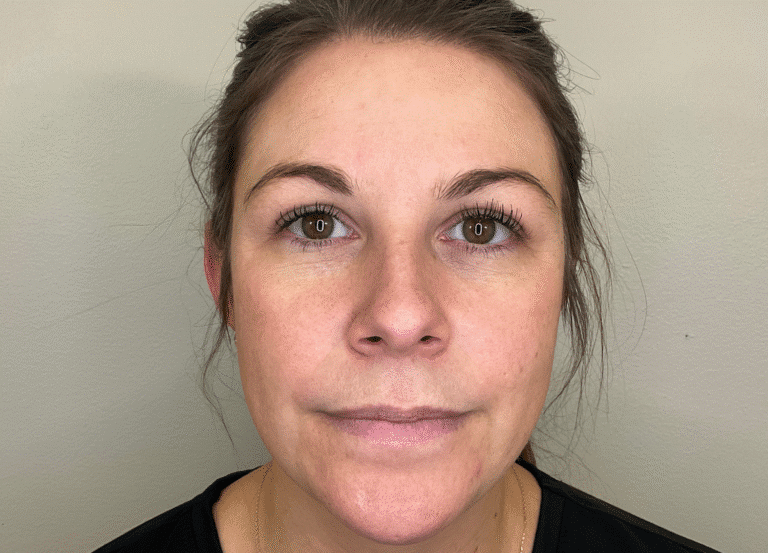 Before Image: Microneedling - front
