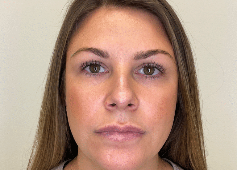 After Image: Microneedling - front