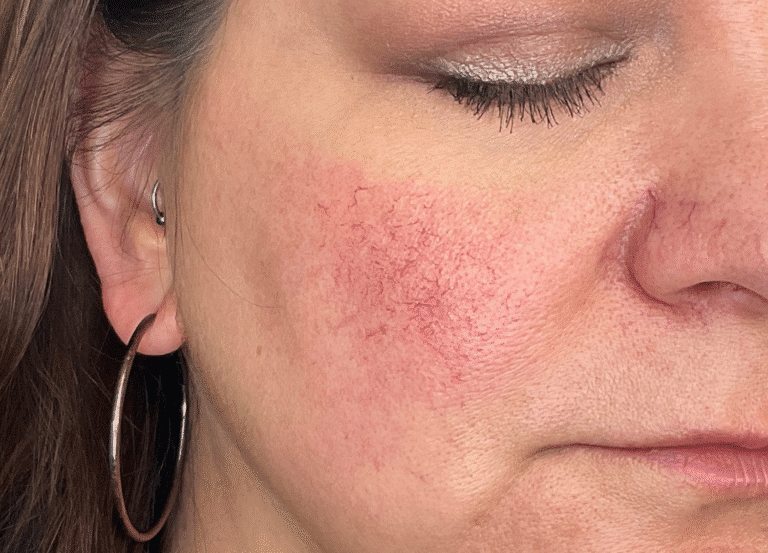 Before Image: Yag: Laser Vein Removal -