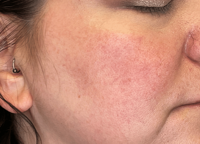 After Image: Yag: Laser Vein Removal -