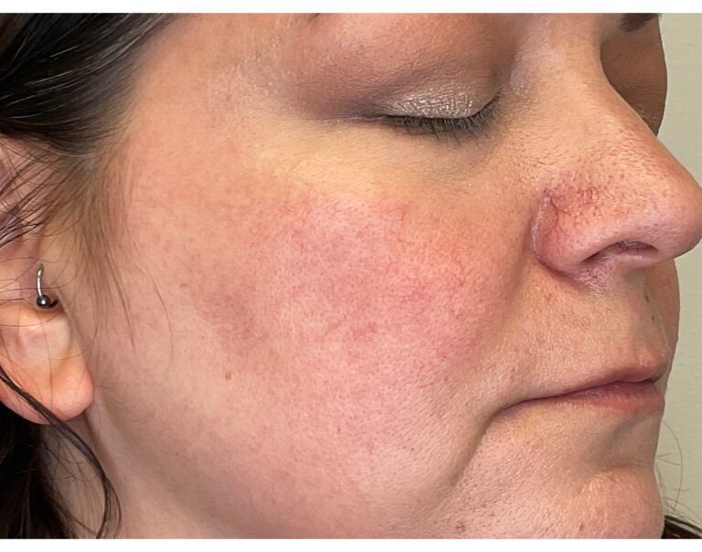 After Image: Yag: Laser Vein Removal - right-front-oblique