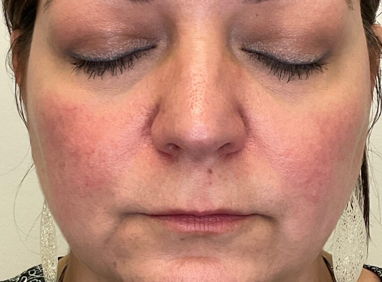 After Image: Yag: Laser Vein Removal - front