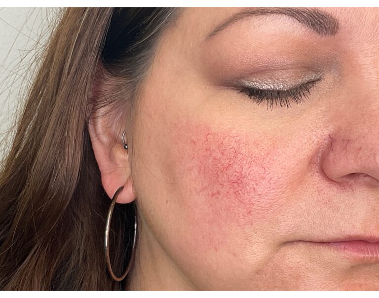 Before Image: Yag: Laser Vein Removal - right-front-oblique