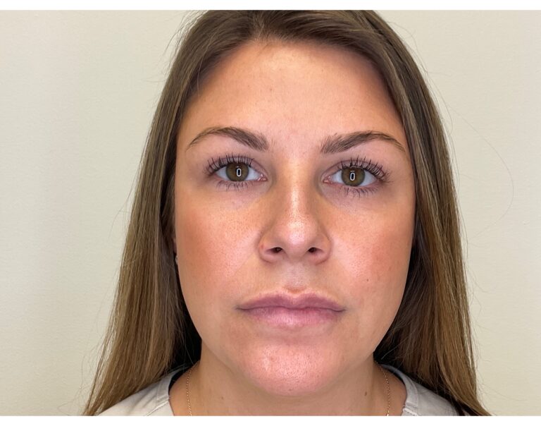 After Image: Microneedling - front