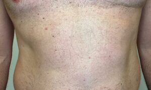 After Image: Tattoo Removal