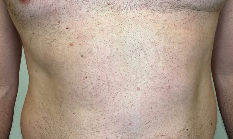 After Image: Tattoo Removal - front