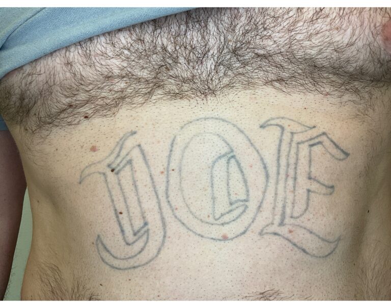 Before Image: Tattoo Removal - front