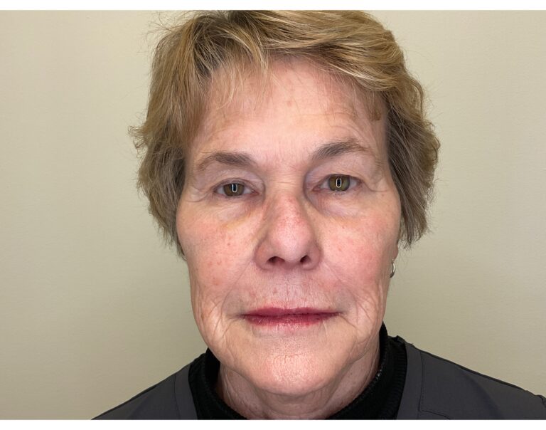 After Image: Facial Fillers - front