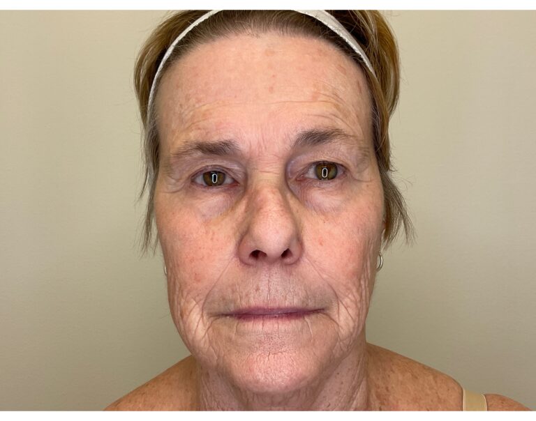Before Image: Facial Fillers - front