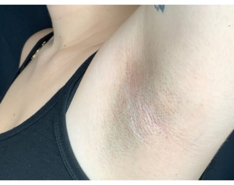 Before Image: Laser Hair Reduction - left-front-oblique
