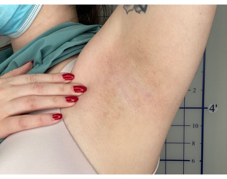 After Image: Laser Hair Reduction - left-front-oblique